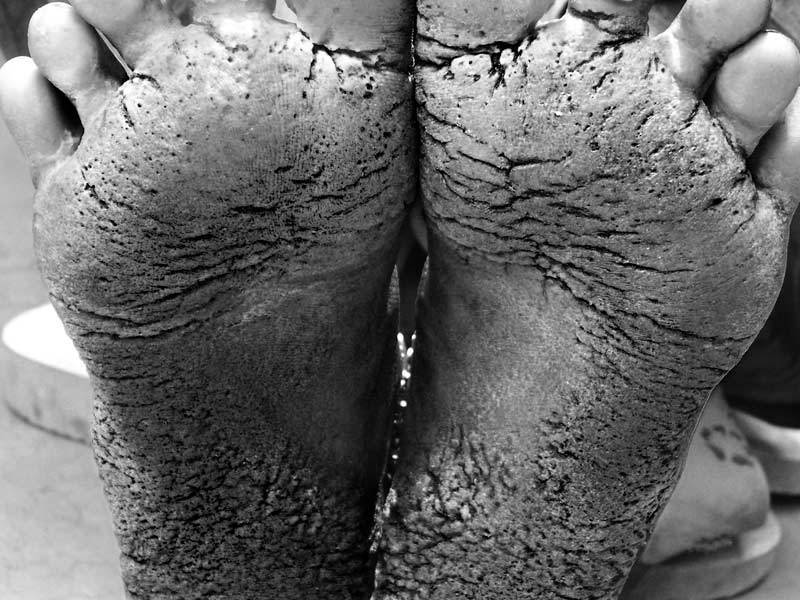 Rural Drinking Water Challenges - A rural lady's feet affected by hyperkeratosis due to prolonged consumption of arsenic contaminated water in Bhojpur district, Bihar